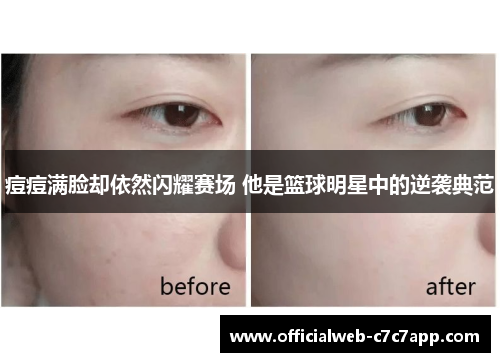 痘痘满脸却依然闪耀赛场 他是篮球明星中的逆袭典范